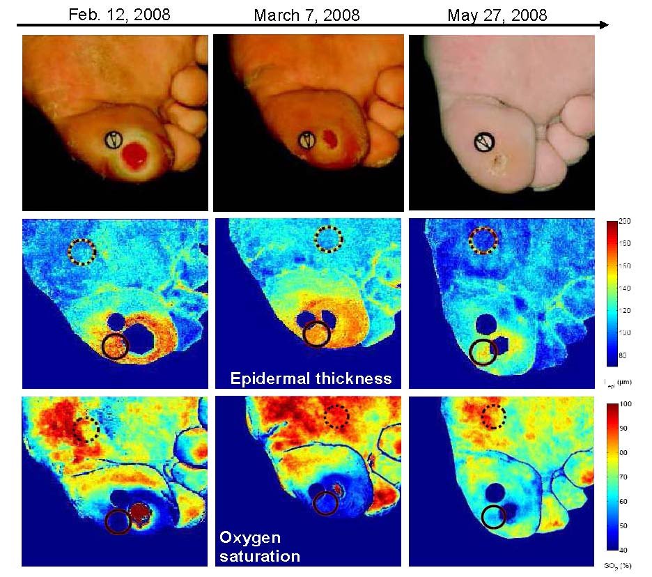 Figure from the explainer: Monitoring temporal development and healing of diabetic foot ulcers