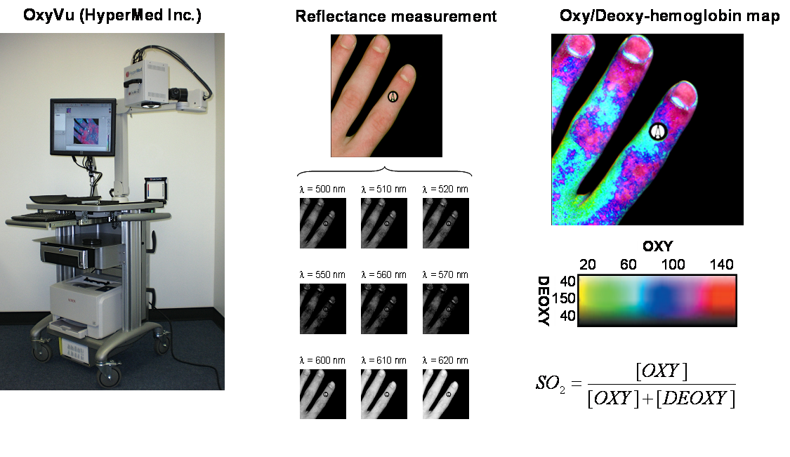 Figure from the explainer: Hyperspectral imaging for early non-invasive detection of wound development on the diabetic foot