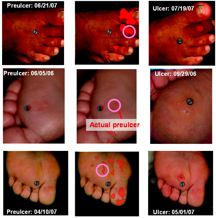 Composite image of three diabetic feet where the red overlay indicates that the maximum absolute differences in oxyhemoglobin and deoxyhemoglobin are such that |MAD(OXY)|> 18 and |MAD(DEOXY)|> 5.8. The approximate locati