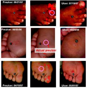 Hyperspectral imaging for early non-invasive detection of wound development on the diabetic foot