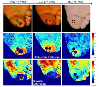 Monitoring temporal development and healing of diabetic foot ulcers